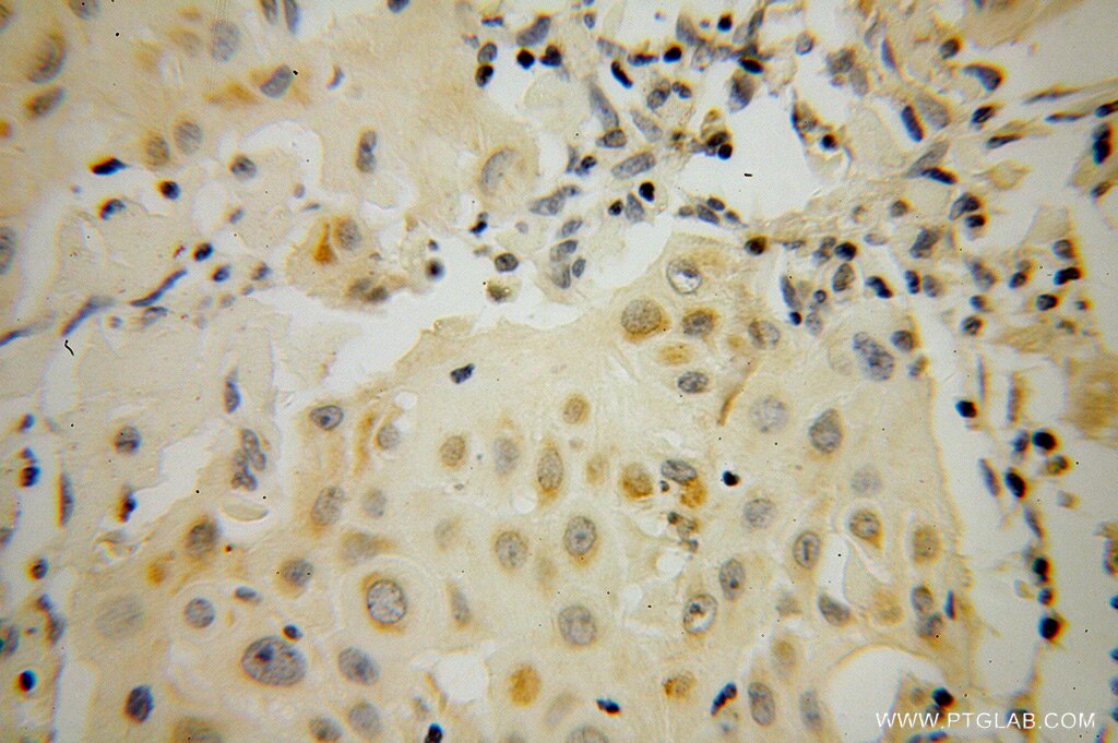 Immunohistochemistry (IHC) staining of human cervical cancer tissue using STAT5A-Specific Polyclonal antibody (51074-2-AP)