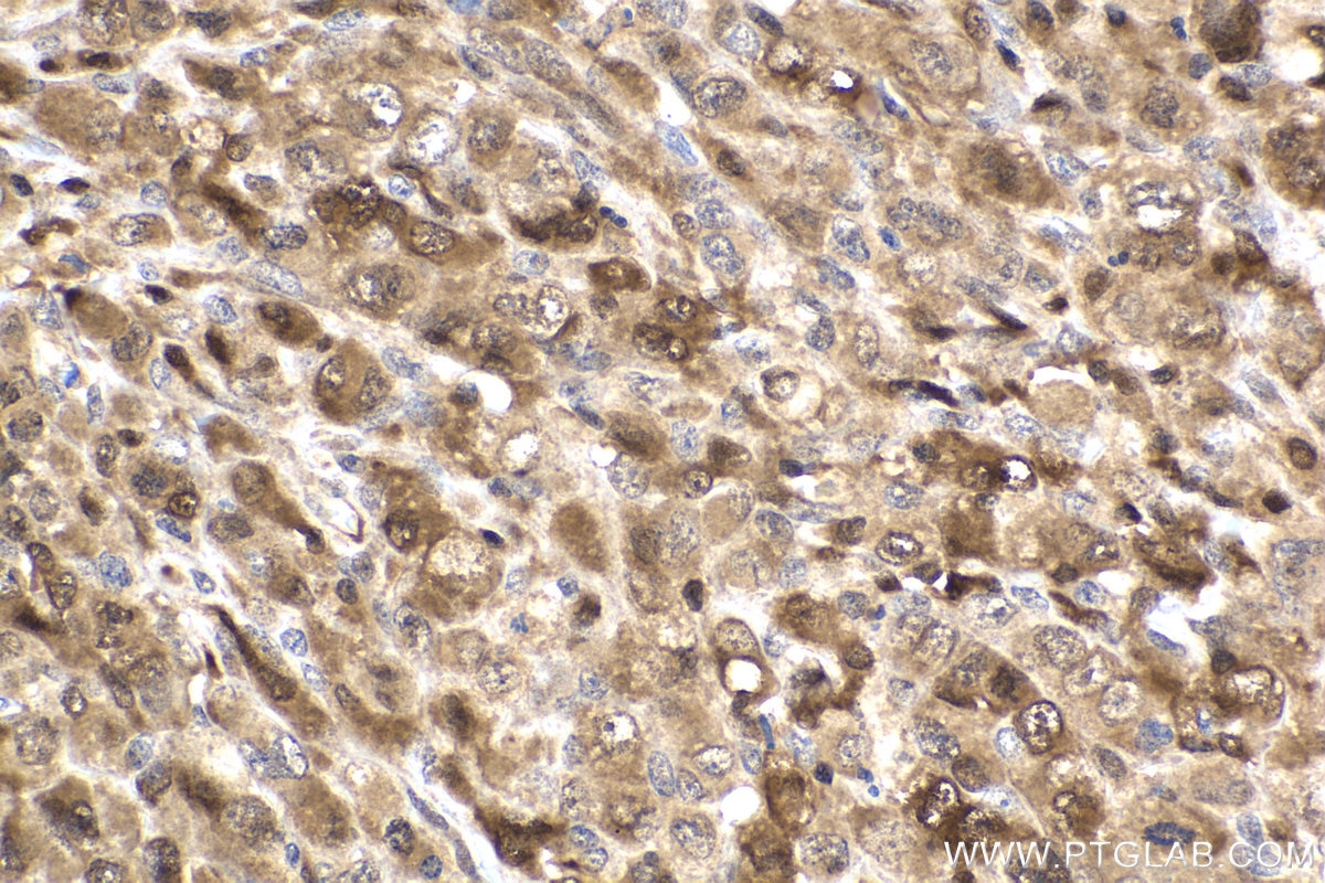 IHC staining of human lymphoma using 66459-1-Ig Immunohistochemistry (IHC) staining of human lymphoma tissue using STAT5A Monoclonal antibody (66459-1-Ig)