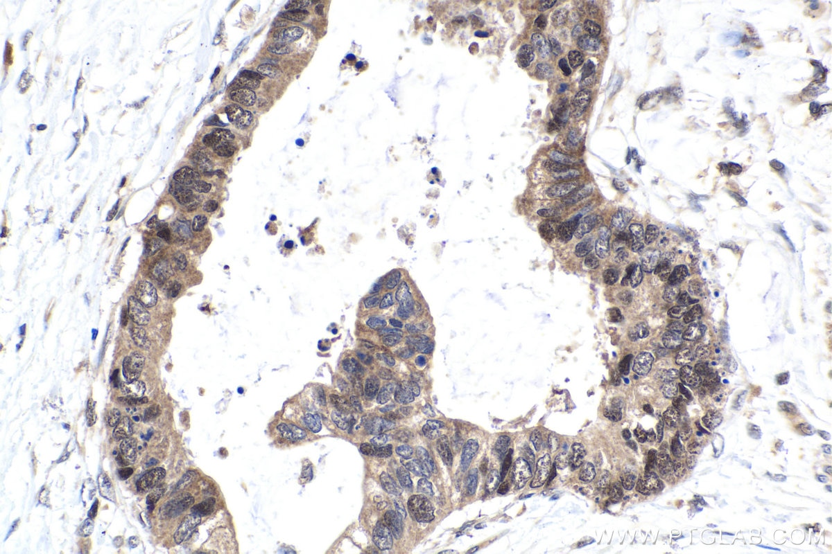 IHC staining of human urothelial carcinoma using 66459-1-Ig Immunohistochemistry (IHC) staining of human urothelial carcinoma tissue using STAT5A Monoclonal antibody (66459-1-Ig)
