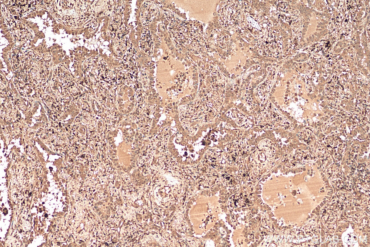 Immunohistochemistry (IHC) staining of human lung cancer tissue using STAT5A/B Polyclonal antibody (12071-1-AP)