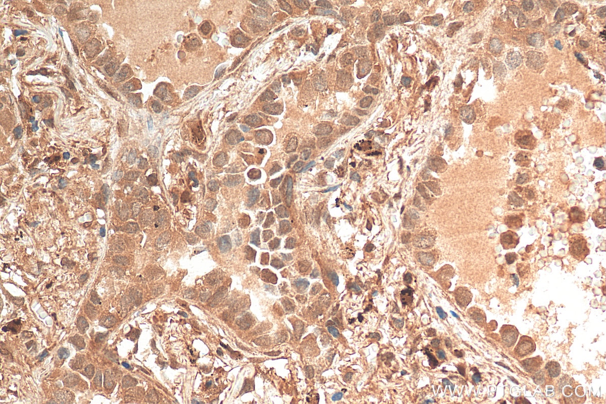 Immunohistochemistry (IHC) staining of human lung cancer tissue using STAT5A/B Polyclonal antibody (12071-1-AP)