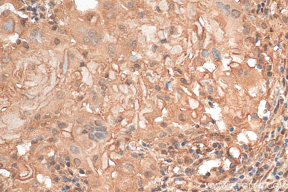 Immunohistochemistry (IHC) staining of human cervical cancer tissue using STAT5A/B Polyclonal antibody (12071-1-AP)