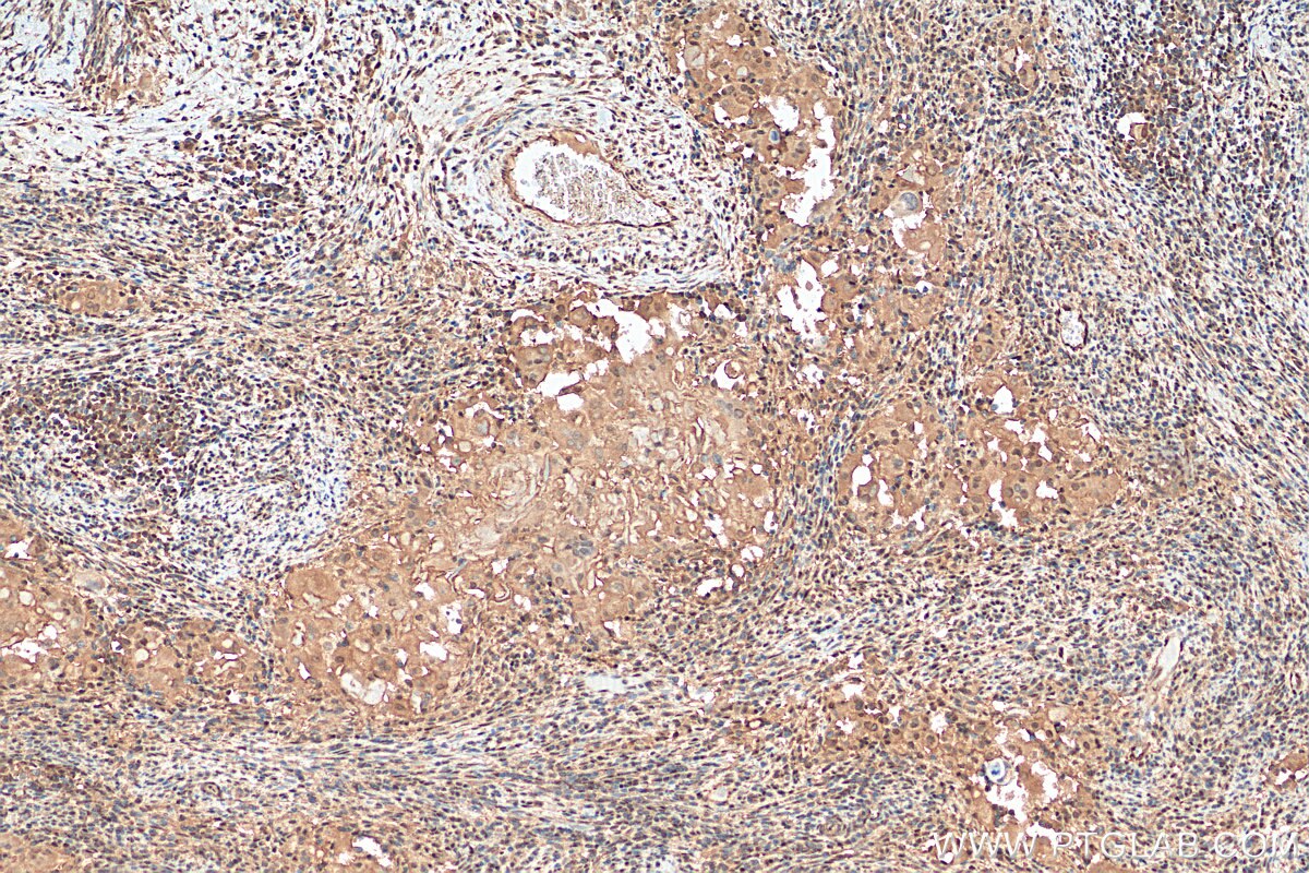 Immunohistochemistry (IHC) staining of human cervical cancer tissue using STAT5A/B Polyclonal antibody (12071-1-AP)