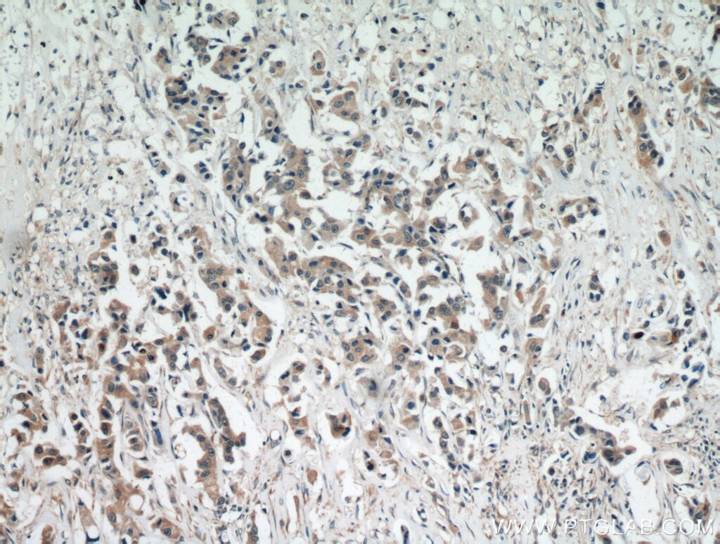 Immunohistochemistry (IHC) staining of human breast cancer tissue using STAT5A/B Polyclonal antibody (12071-1-AP)