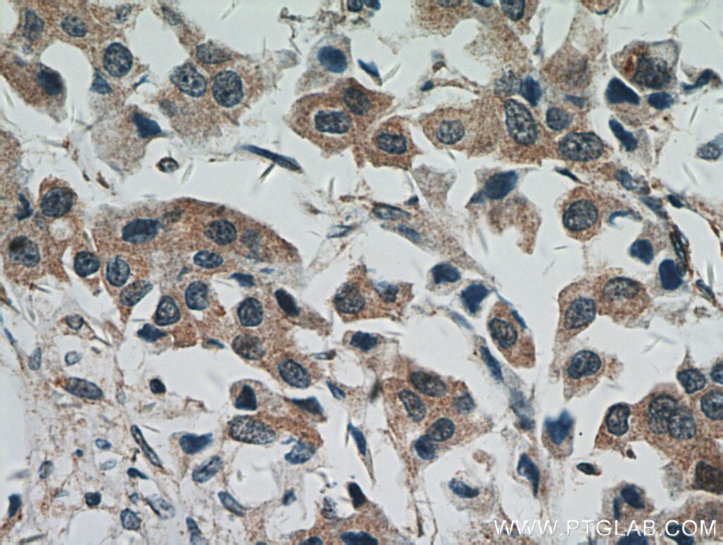 Immunohistochemistry (IHC) staining of human breast cancer tissue using STAT5A/B Polyclonal antibody (12071-1-AP)