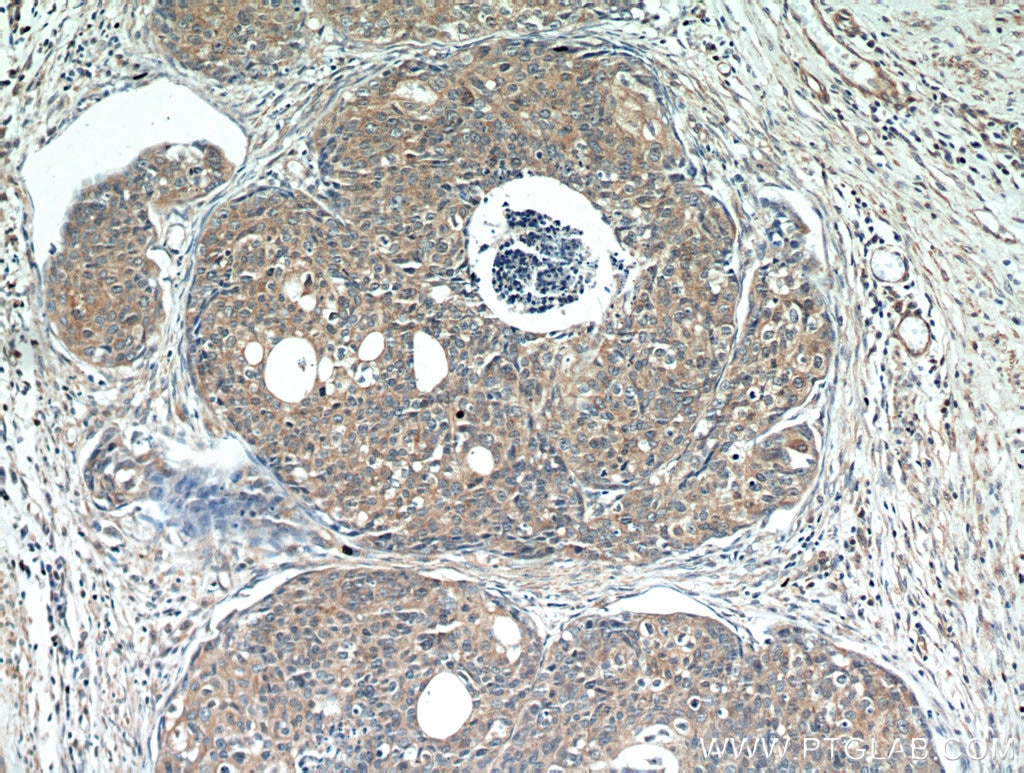 IHC staining of human cervical cancer using 12071-1-AP