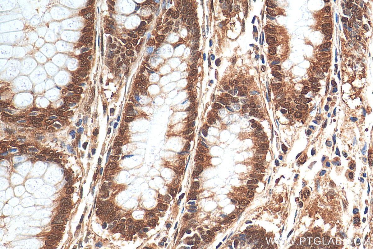 Immunohistochemistry (IHC) staining of human colon cancer tissue using STAT6 Polyclonal antibody (51073-1-AP)