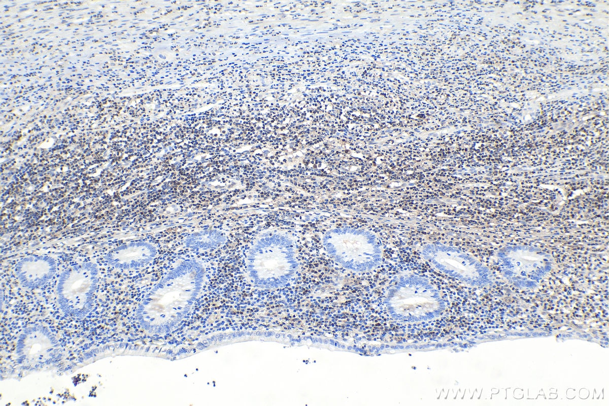 IHC staining of human appendicitis using 66717-1-Ig