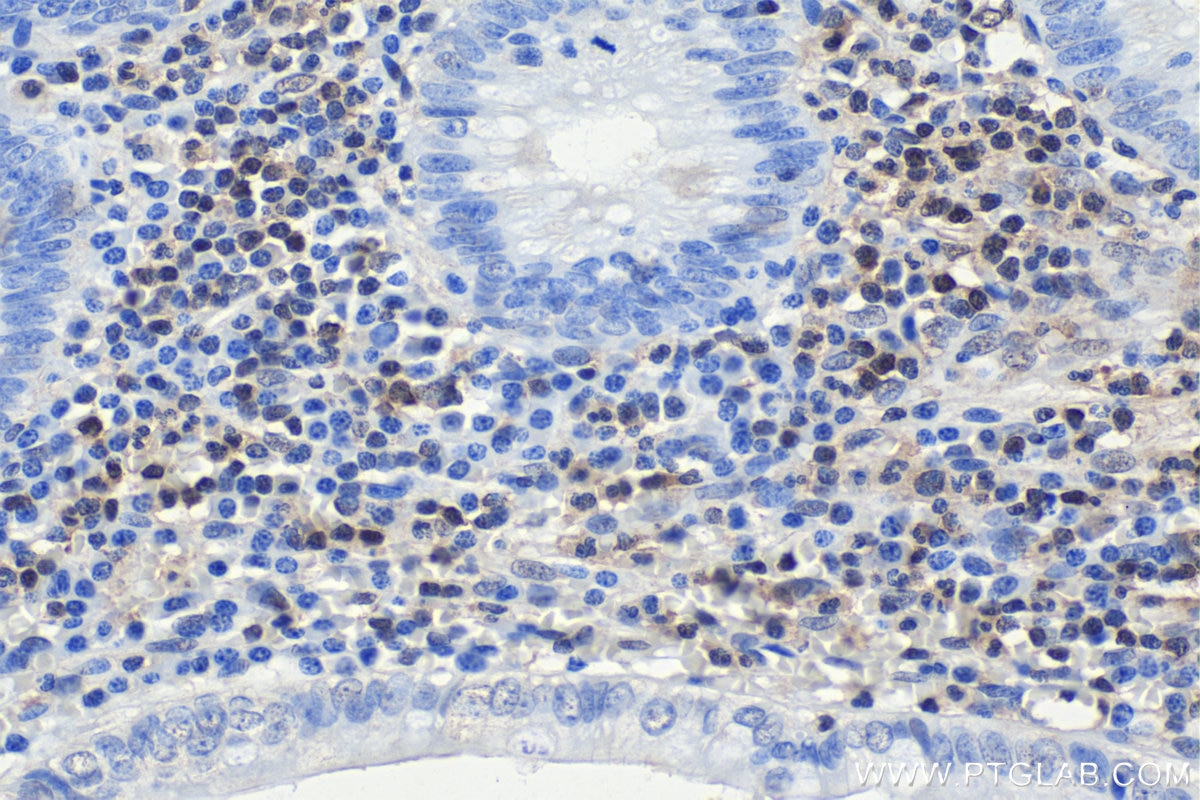 Immunohistochemistry (IHC) staining of human appendicitis tissue using STAT6 Monoclonal antibody (66717-1-Ig)