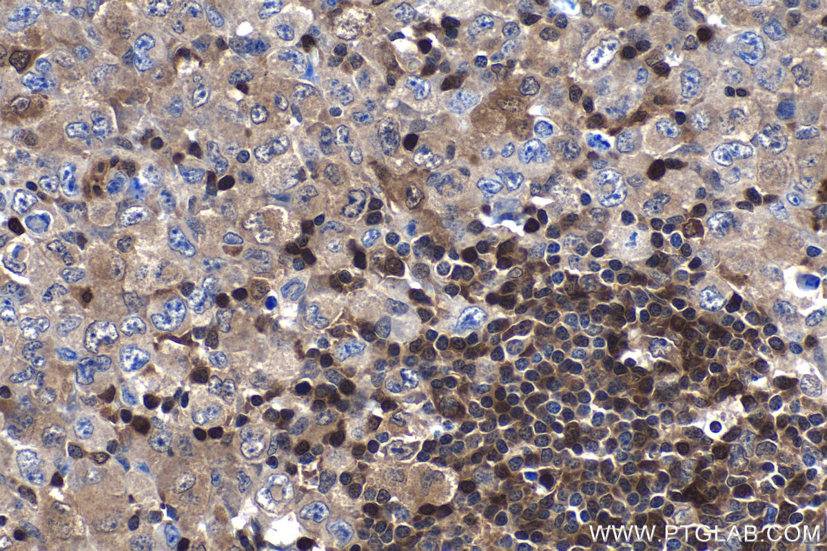 Immunohistochemistry (IHC) staining of human lymphoma tissue using STAT6 Monoclonal antibody (66717-1-Ig)