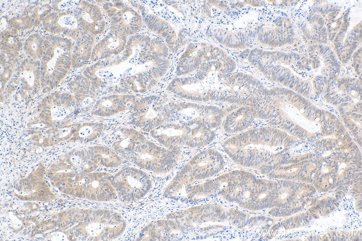 Immunohistochemistry (IHC) staining of human colon cancer tissue using STAT6 Recombinant antibody (82630-1-RR)