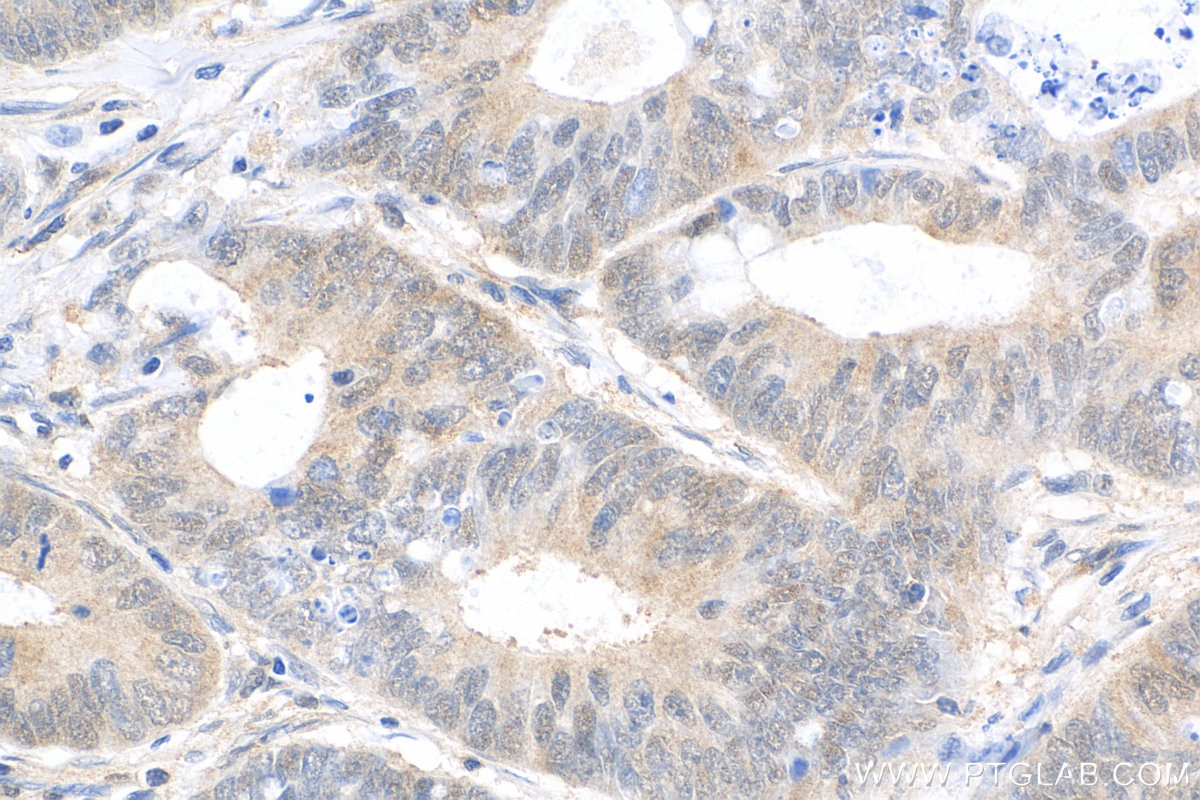 Immunohistochemistry (IHC) staining of human colon cancer tissue using STAT6 Recombinant antibody (82630-1-RR)