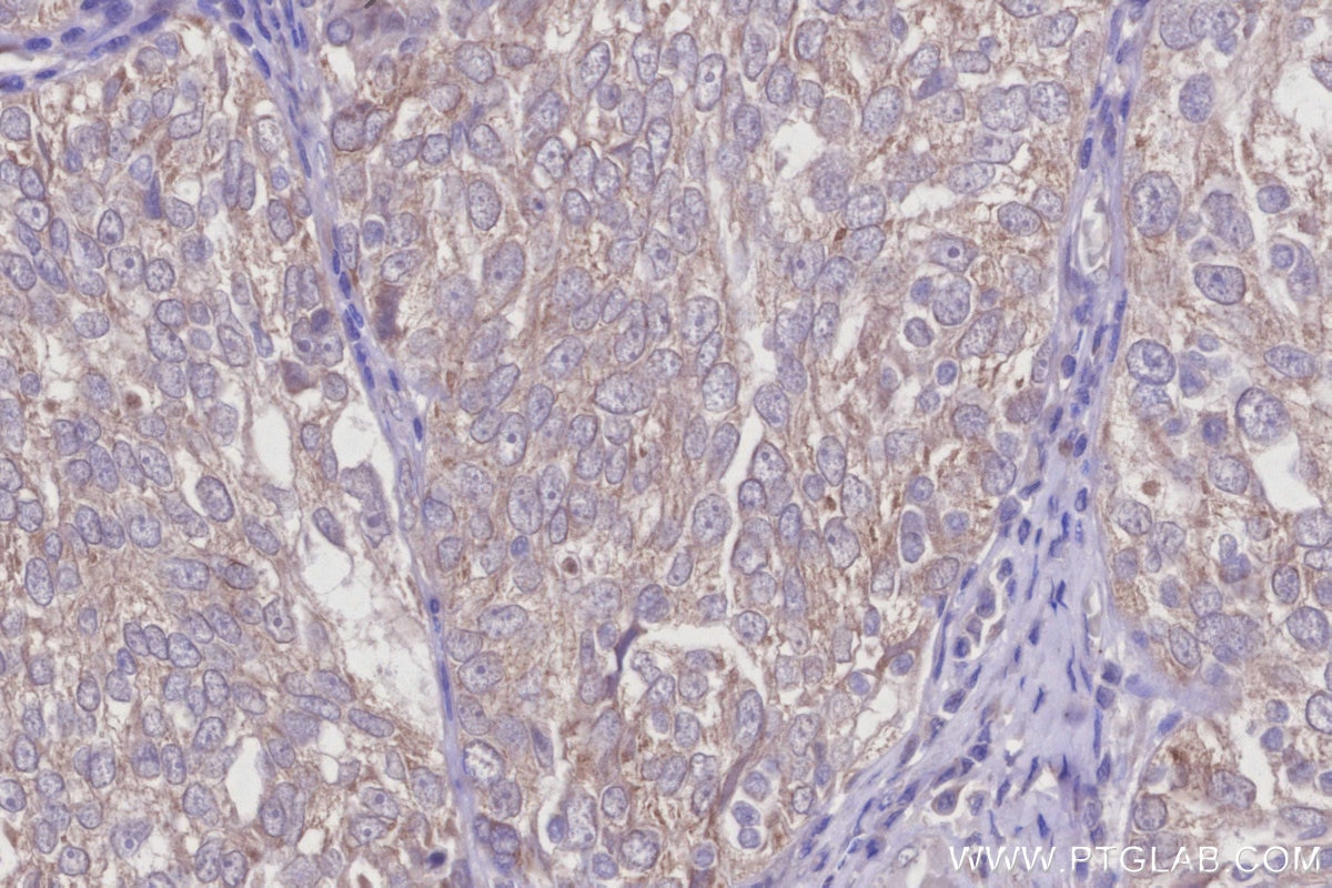 IHC staining of human ovary cancer using 15998-1-AP Immunohistochemistry (IHC) staining of human ovary cancer tissue using STAU2 Polyclonal antibody (15998-1-AP)