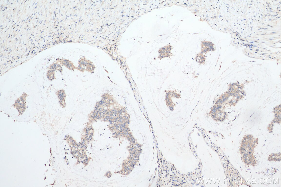 Immunohistochemistry (IHC) staining of human colon cancer tissue using STBD1 Polyclonal antibody (11842-1-AP)