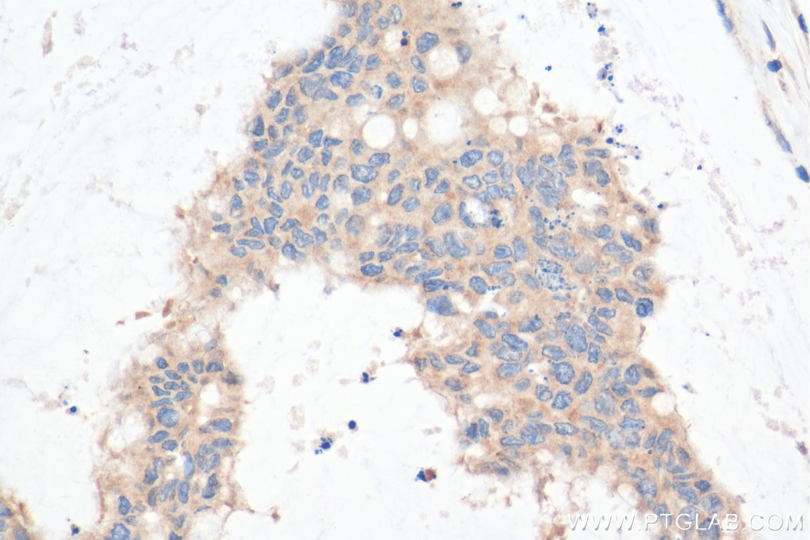 Immunohistochemistry (IHC) staining of human colon cancer tissue using STBD1 Polyclonal antibody (11842-1-AP)
