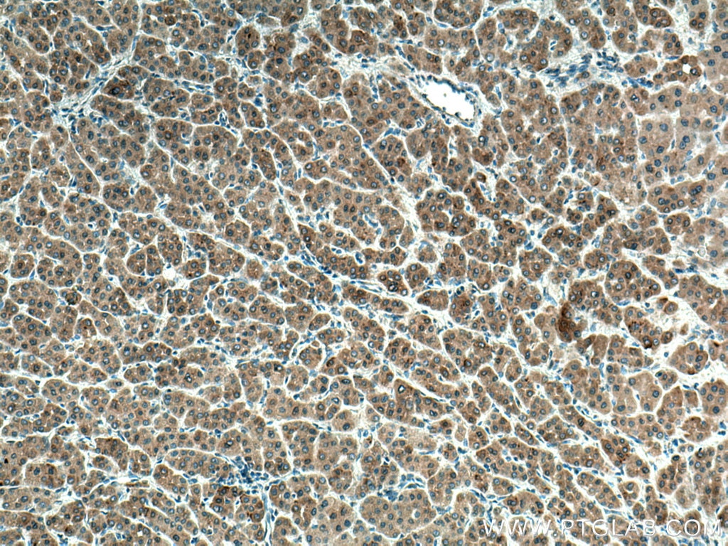 Immunohistochemistry (IHC) staining of human liver cancer tissue using STBD1 Monoclonal antibody (67018-1-Ig)