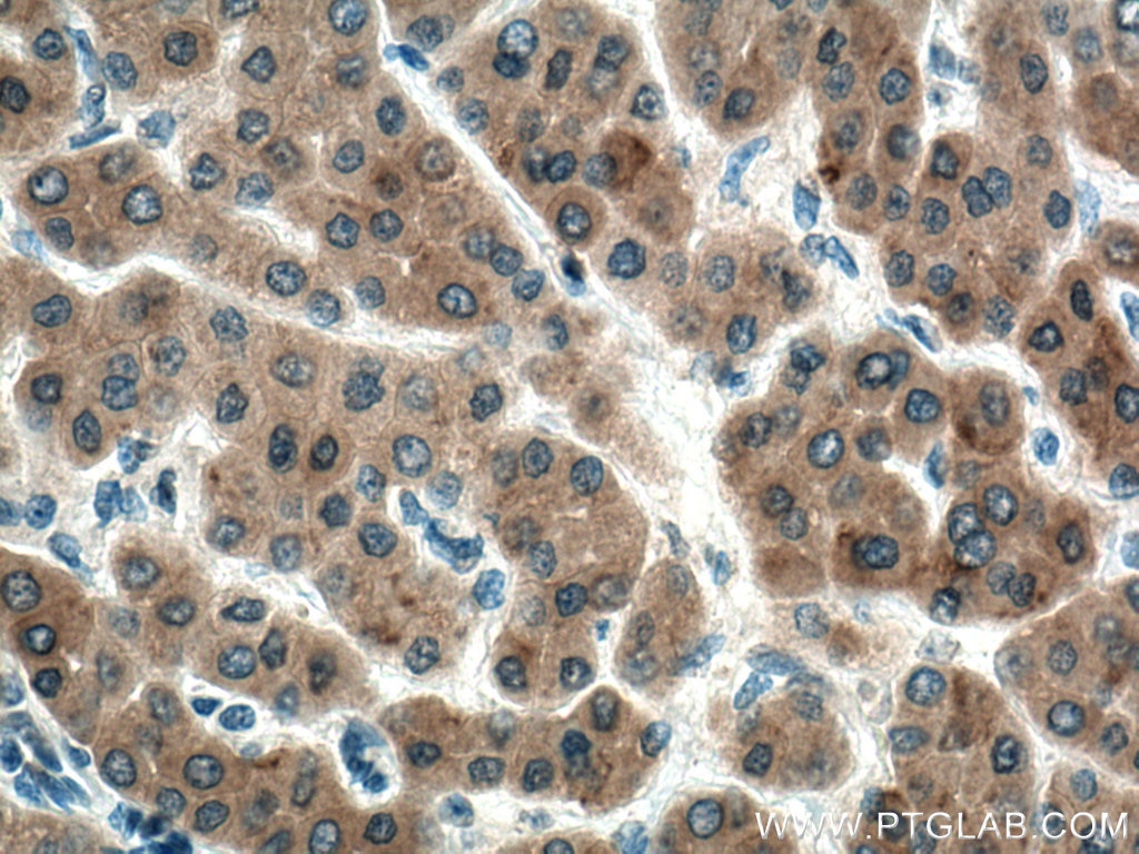 Immunohistochemistry (IHC) staining of human liver cancer tissue using STBD1 Monoclonal antibody (67018-1-Ig)