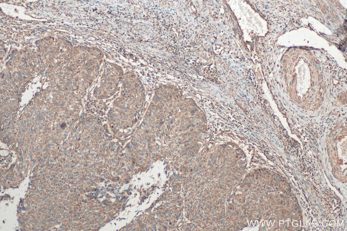 Immunohistochemistry (IHC) staining of human cervical cancer tissue using STC1 Polyclonal antibody (20621-1-AP)