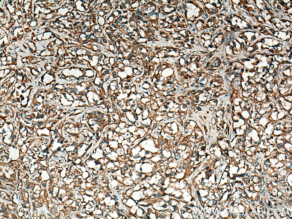 Immunohistochemistry (IHC) staining of human renal cell carcinoma tissue using Stanniocalcin 2 Polyclonal antibody (10314-1-AP)