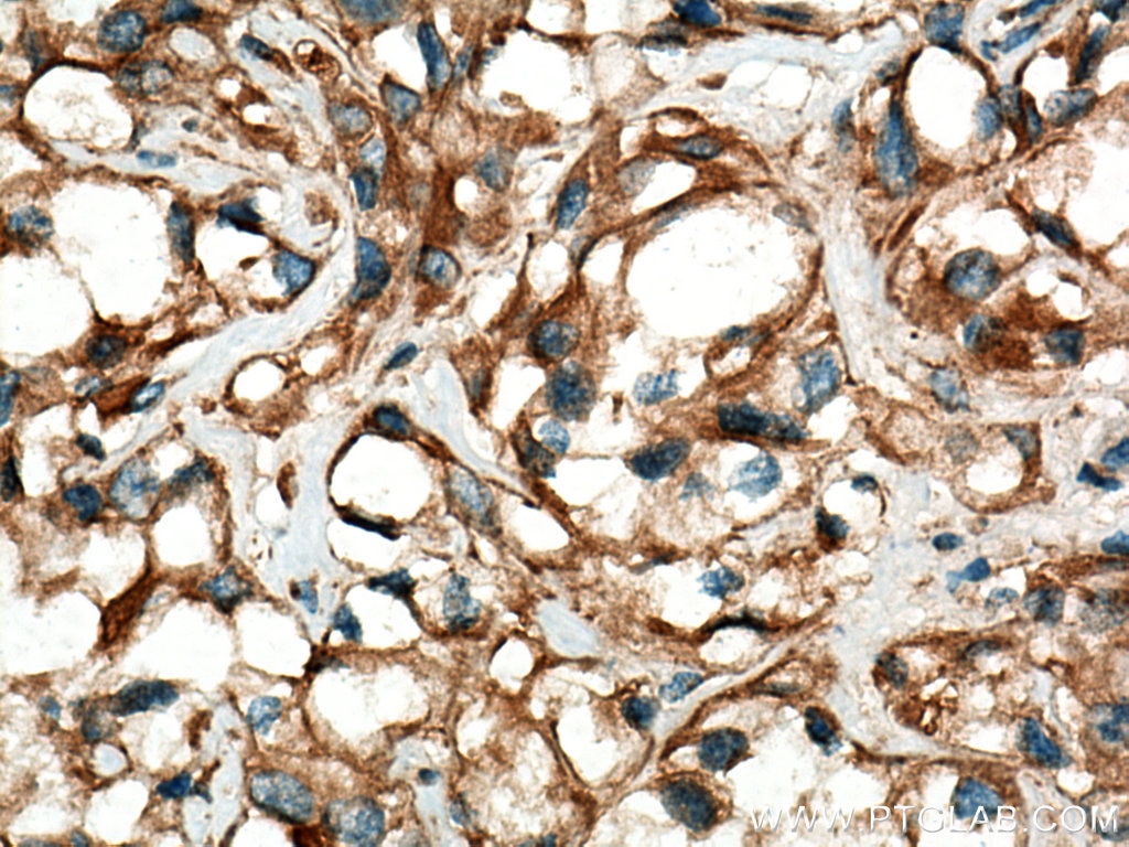 Immunohistochemistry (IHC) staining of human renal cell carcinoma tissue using Stanniocalcin 2 Polyclonal antibody (10314-1-AP)