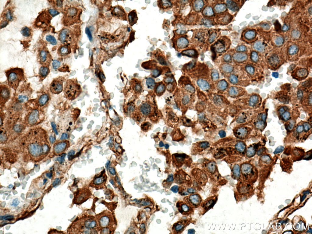 Immunohistochemistry (IHC) staining of human lung cancer tissue using Stanniocalcin 2 Polyclonal antibody (10314-1-AP)