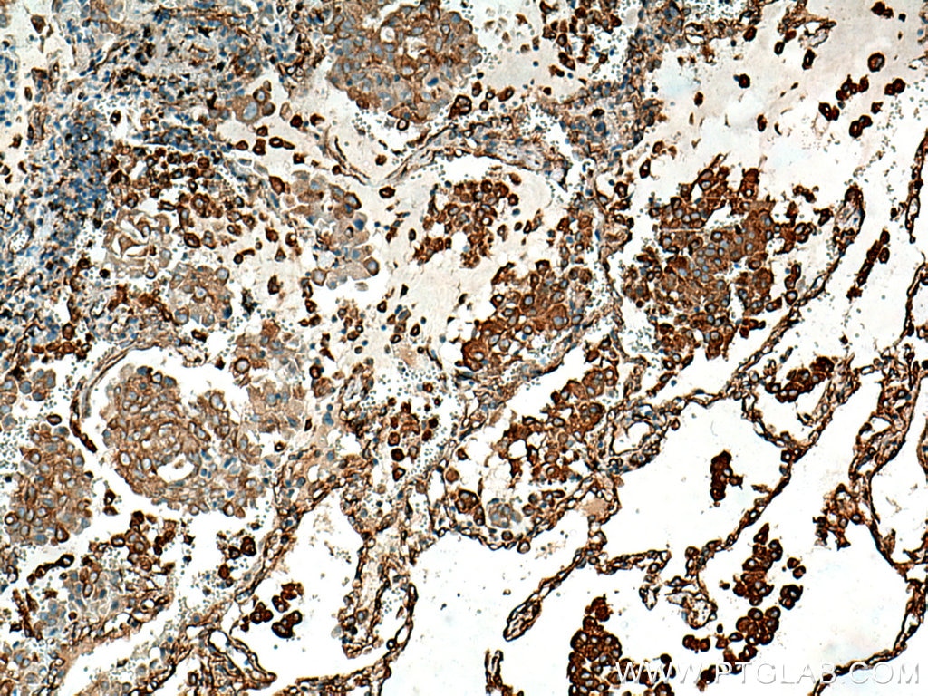 Immunohistochemistry (IHC) staining of human lung cancer tissue using Stanniocalcin 2 Polyclonal antibody (10314-1-AP)