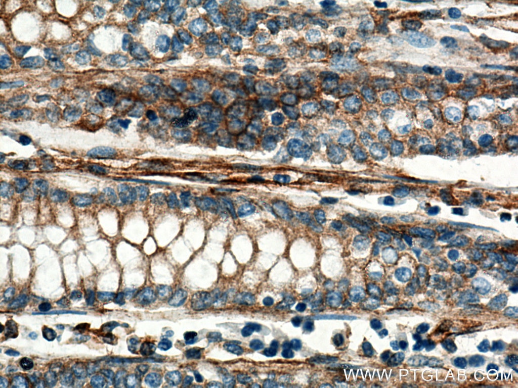 Immunohistochemistry (IHC) staining of human colon cancer tissue using Stanniocalcin 2 Polyclonal antibody (10314-1-AP)