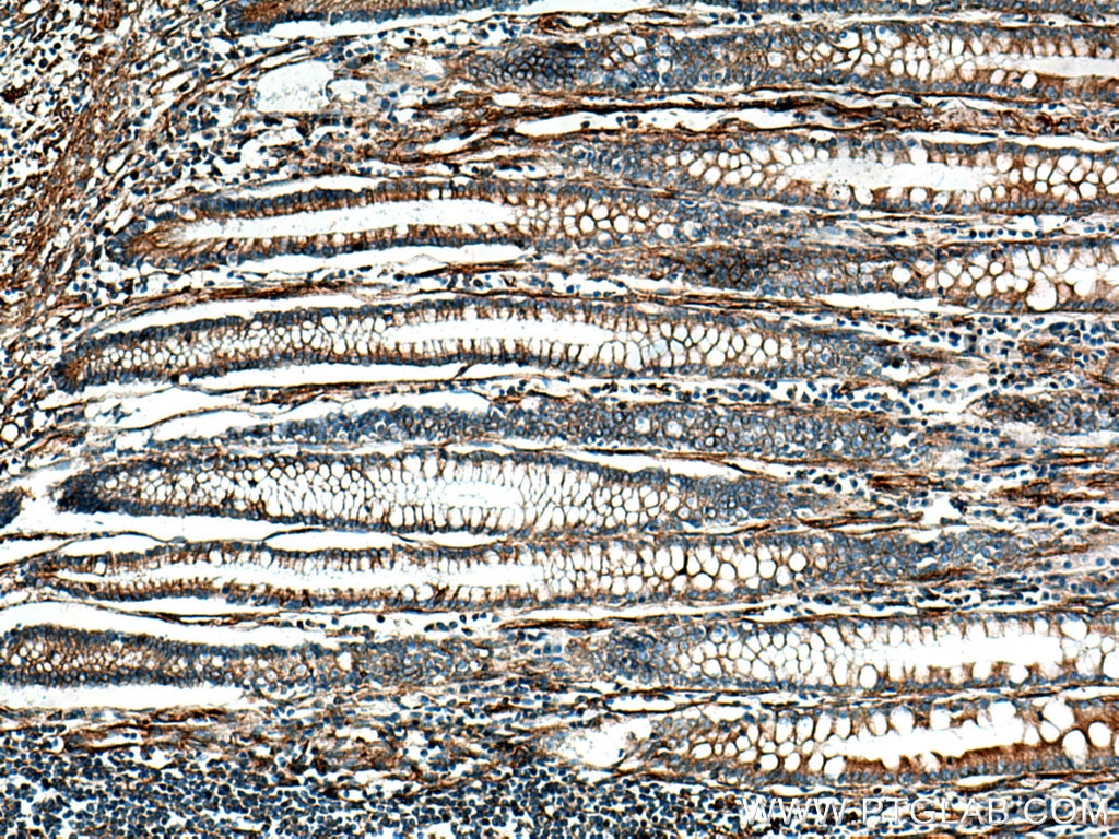 IHC staining of human colon cancer using 10314-1-AP