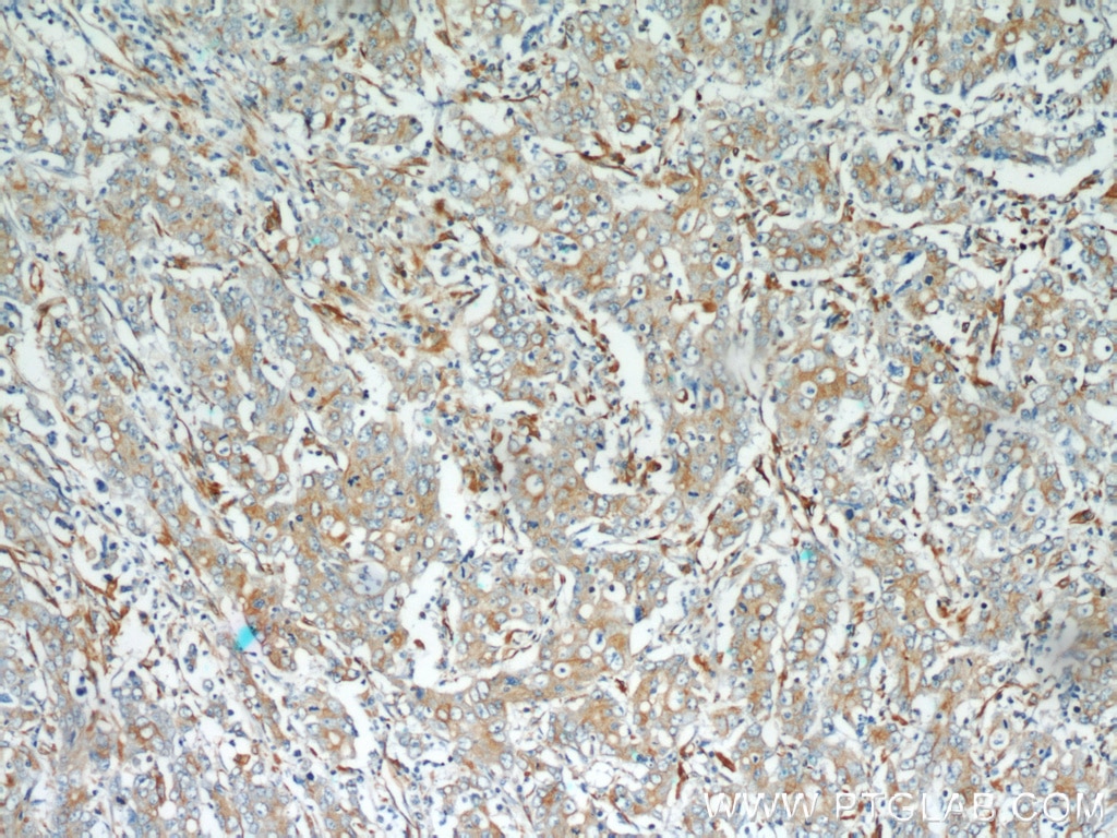 Immunohistochemistry (IHC) staining of human stomach cancer tissue using Stanniocalcin 2 Polyclonal antibody (10314-1-AP)