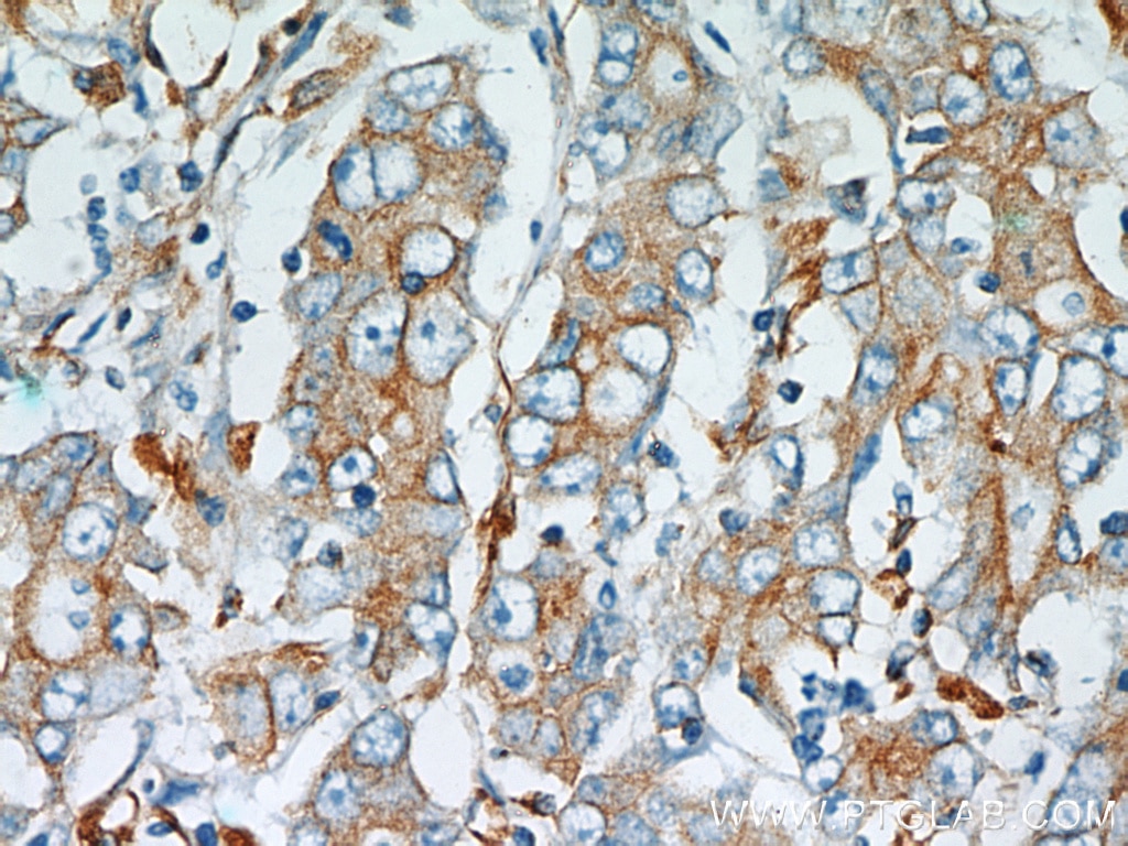 Immunohistochemistry (IHC) staining of human stomach cancer tissue using Stanniocalcin 2 Polyclonal antibody (10314-1-AP)