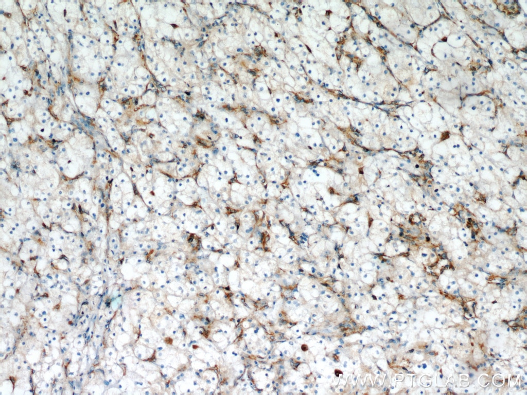 IHC staining of human renal cell carcinoma using 10314-1-AP