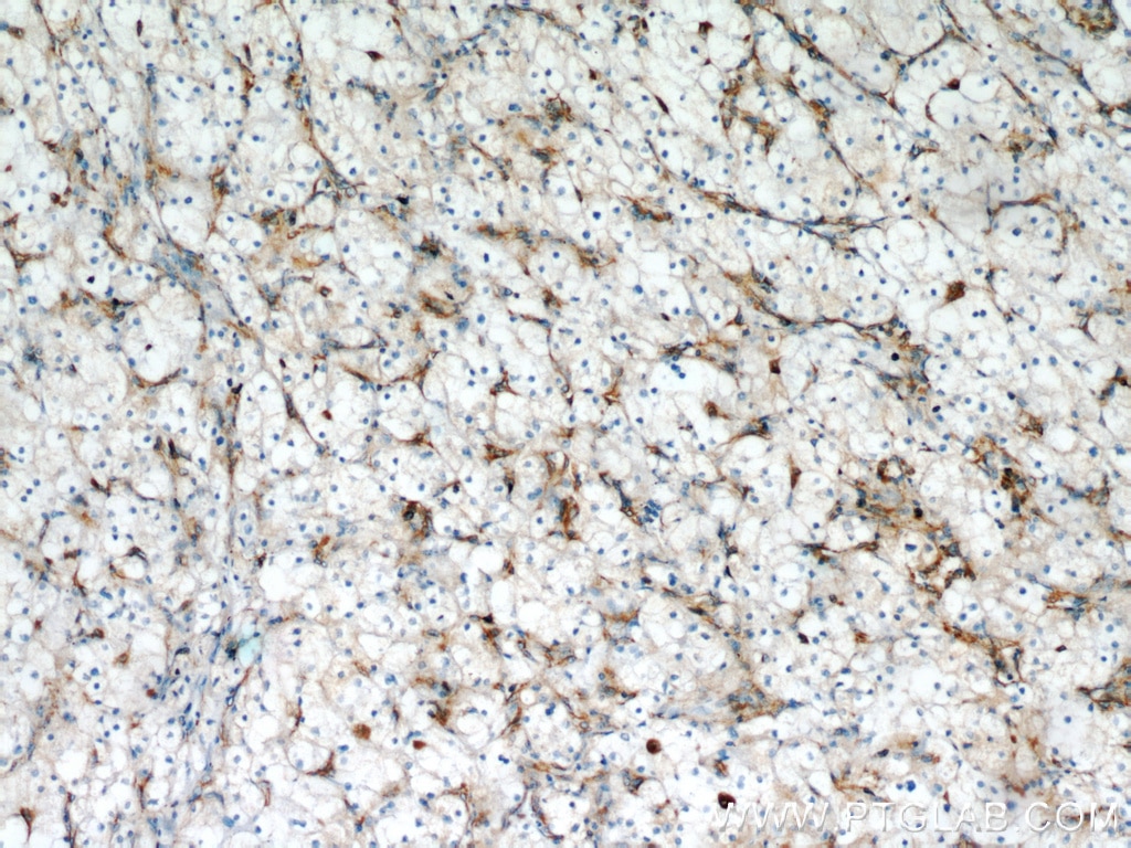 Immunohistochemistry (IHC) staining of human renal cell carcinoma tissue using Stanniocalcin 2 Polyclonal antibody (10314-1-AP)