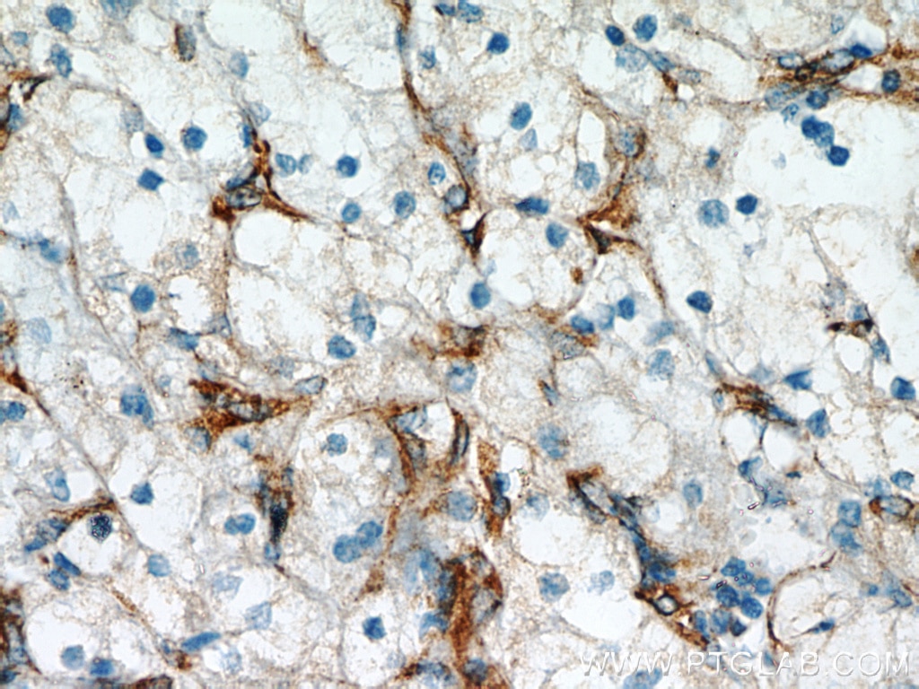 Immunohistochemistry (IHC) staining of human renal cell carcinoma tissue using Stanniocalcin 2 Polyclonal antibody (10314-1-AP)
