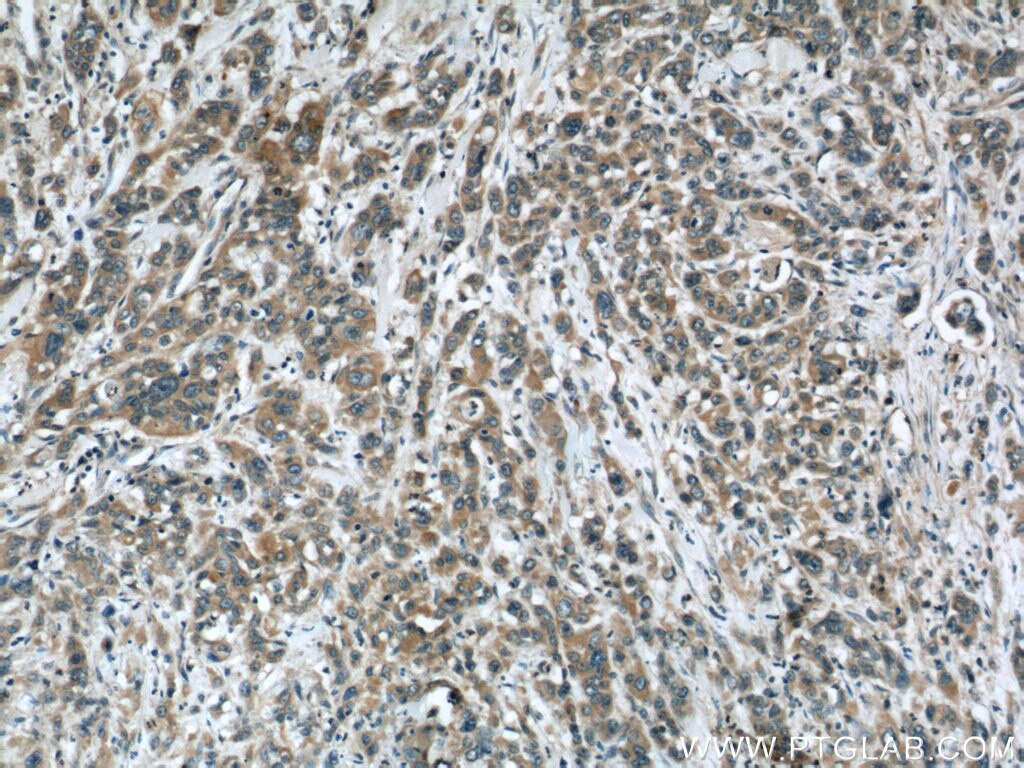 Immunohistochemistry (IHC) staining of human stomach cancer tissue using Stanniocalcin 2 Monoclonal antibody (60063-1-Ig)