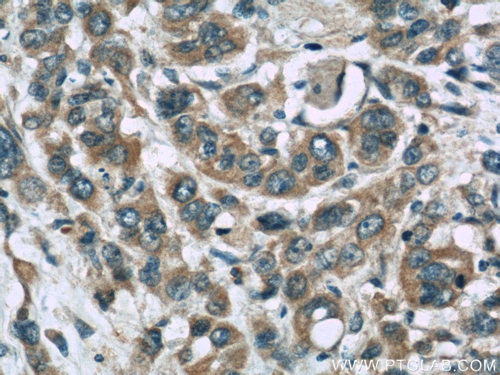 Immunohistochemistry (IHC) staining of human stomach cancer tissue using Stanniocalcin 2 Monoclonal antibody (60063-1-Ig)