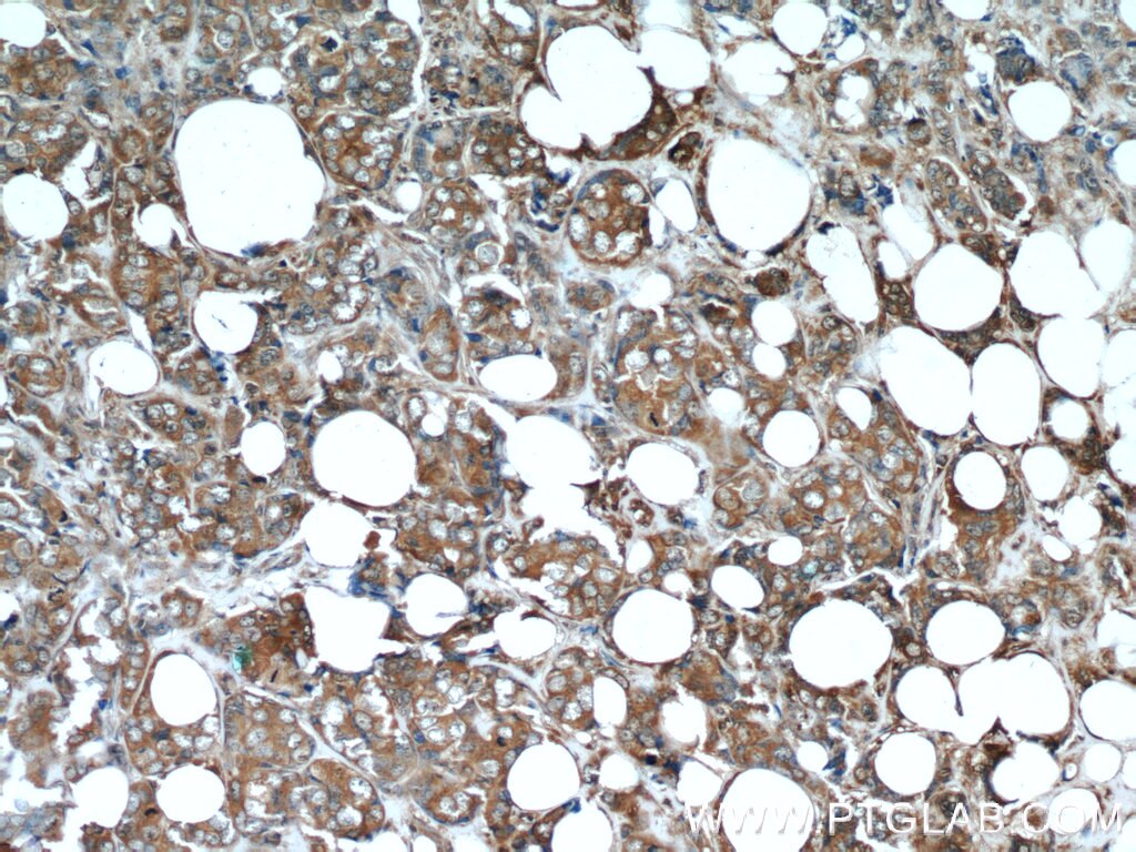 Immunohistochemistry (IHC) staining of human breast cancer tissue using Stanniocalcin 2 Monoclonal antibody (60063-1-Ig)