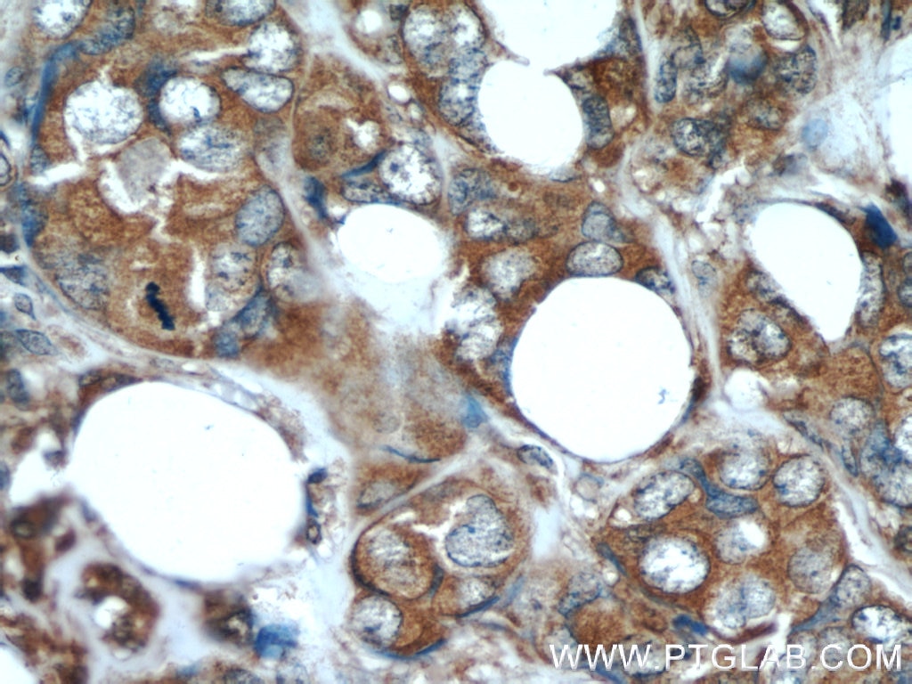 Immunohistochemistry (IHC) staining of human breast cancer tissue using Stanniocalcin 2 Monoclonal antibody (60063-1-Ig)
