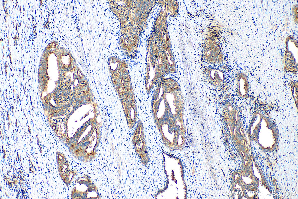 Immunohistochemistry (IHC) staining of human prostate cancer tissue using STEAP1 Polyclonal antibody (20199-1-AP)