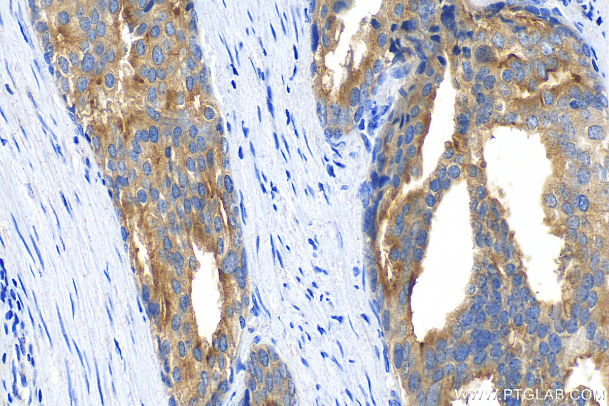 Immunohistochemistry (IHC) staining of human prostate cancer tissue using STEAP1 Polyclonal antibody (20199-1-AP)