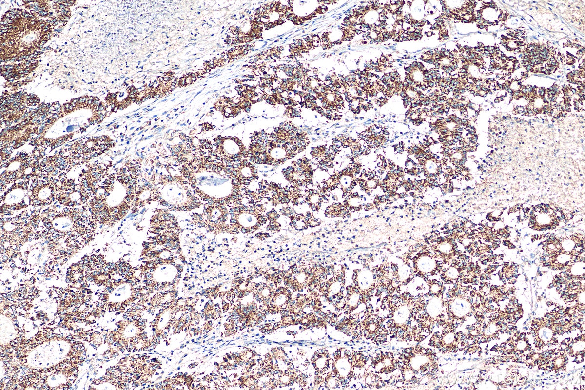 Immunohistochemistry (IHC) staining of human colon cancer tissue using STEAP2 Polyclonal antibody (24804-1-AP)