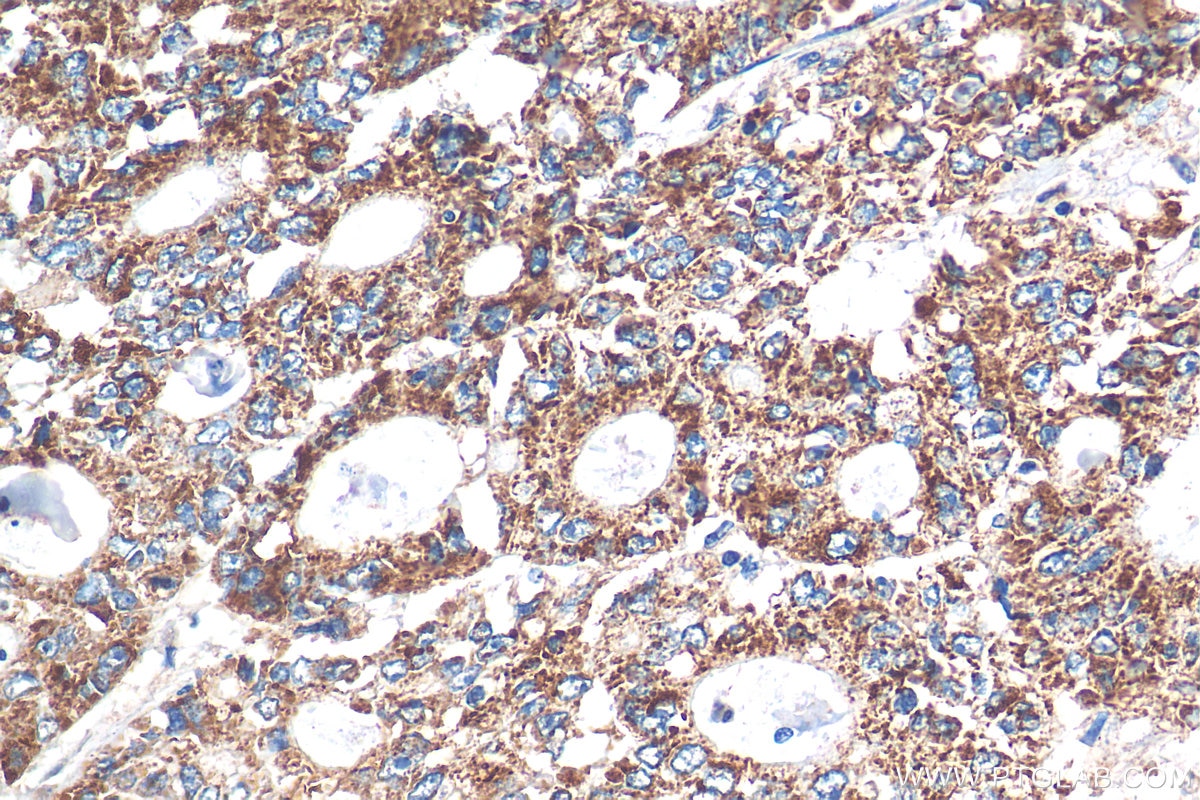 Immunohistochemistry (IHC) staining of human colon cancer tissue using STEAP2 Polyclonal antibody (24804-1-AP)
