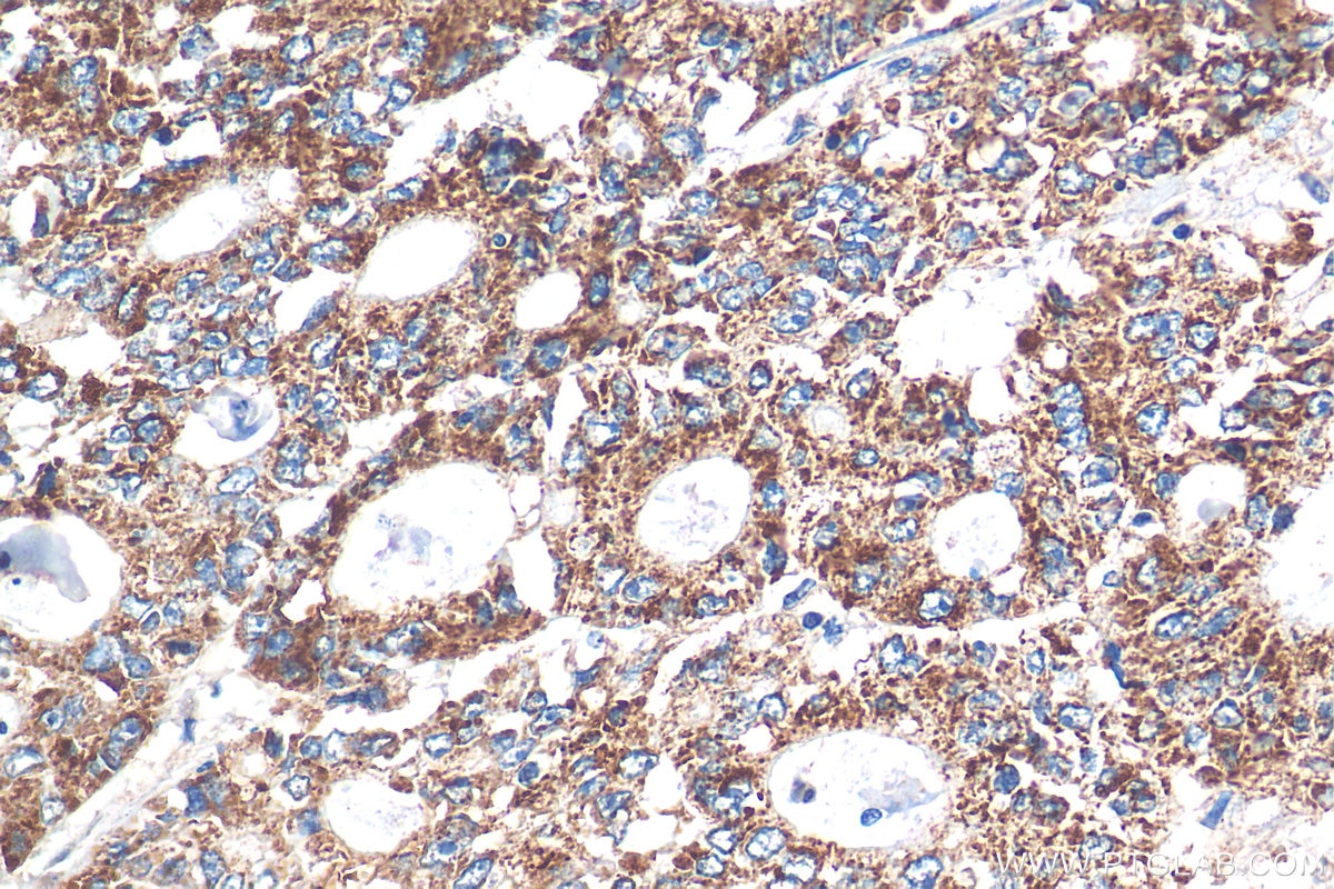 Immunohistochemistry (IHC) staining of human colon cancer tissue using STEAP2 Polyclonal antibody (24804-1-AP)