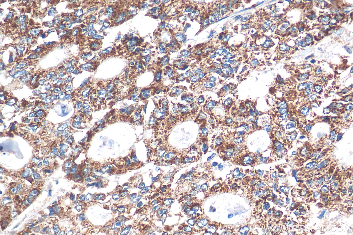 IHC staining of human colon cancer using 24804-1-AP