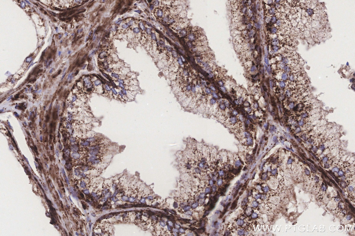 IHC staining of human prostate cancer using 83611-3-RR Immunohistochemistry (IHC) staining of human prostate cancer tissue using STEAP2 Recombinant monoclonal antibody (83611-3-RR)