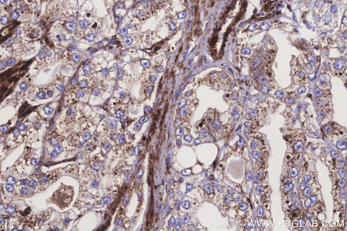 IHC staining of human prostate cancer using 83611-3-RR Immunohistochemistry (IHC) staining of human prostate cancer tissue using STEAP2 Recombinant monoclonal antibody (83611-3-RR)