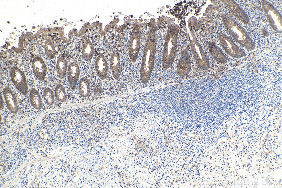Immunohistochemistry (IHC) staining of human appendicitis tissue using STEAP3 Polyclonal antibody (28478-1-AP)