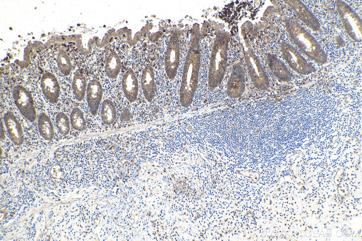 IHC staining of human appendicitis using 28478-1-AP