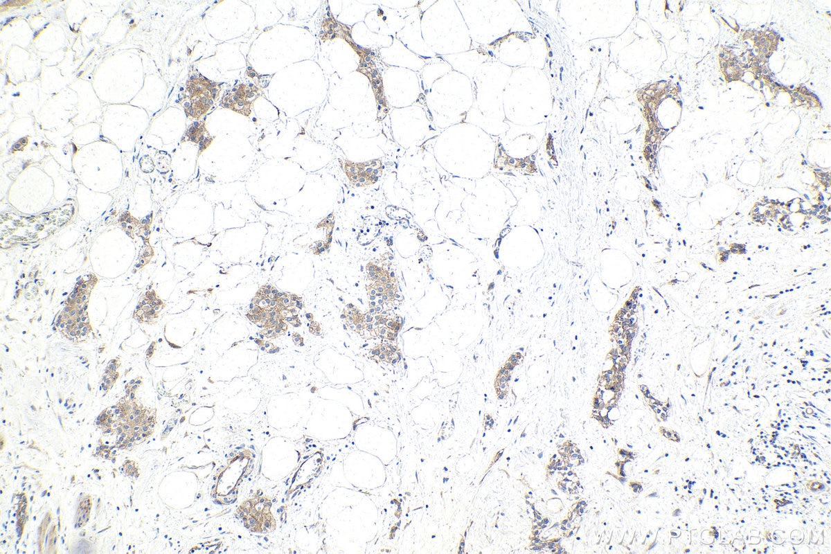 IHC staining of human urothelial carcinoma using 28478-1-AP