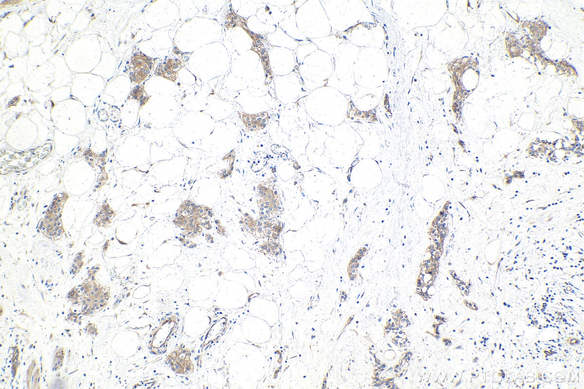 Immunohistochemistry (IHC) staining of human urothelial carcinoma tissue using STEAP3 Polyclonal antibody (28478-1-AP)