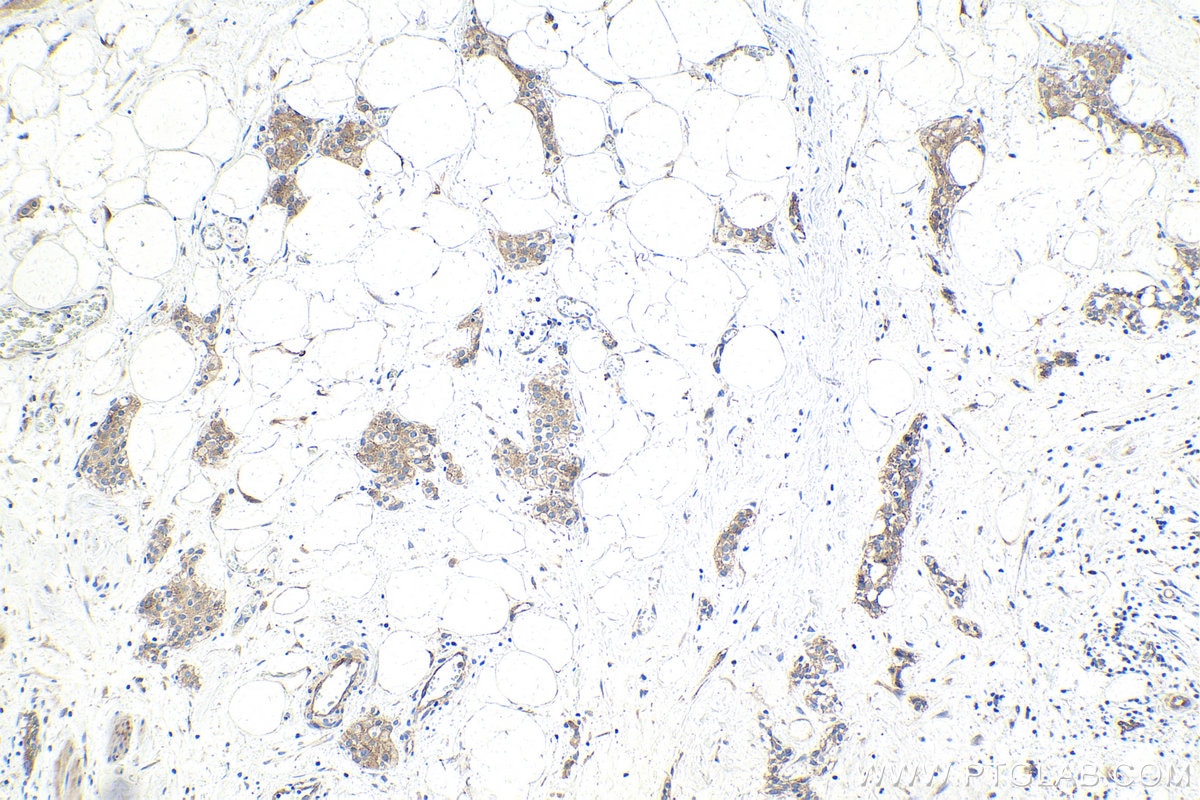 Immunohistochemistry (IHC) staining of human urothelial carcinoma tissue using STEAP3 Polyclonal antibody (28478-1-AP)